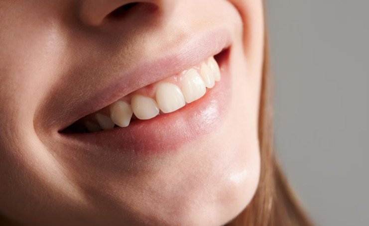 Diş Beyazlatma Ne Kadar Kalıcıdır?