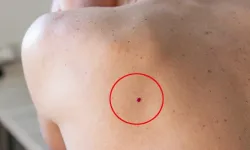 Cilt kanseri: Erken teşhis hayat kurtarır
