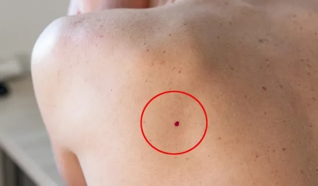 Cilt kanseri: Erken teşhis hayat kurtarır