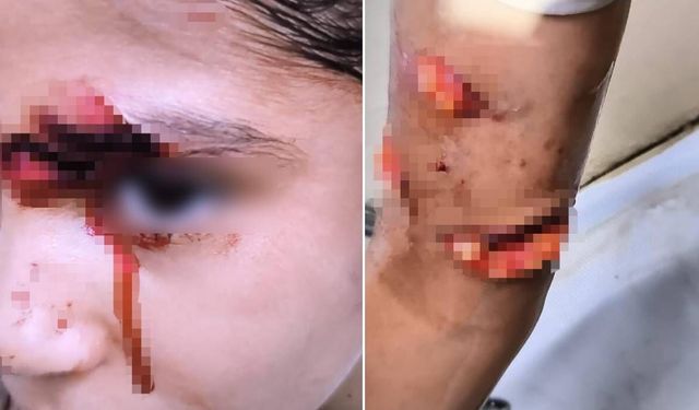 Köpeklerin Saldırdığı 8 Yaşındaki Çocuğa 150 Dikiş Atıldı